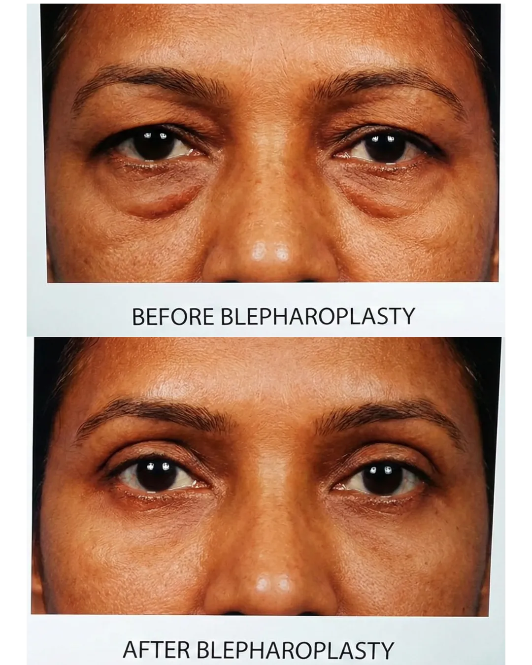 Cosmo Radiance result: Droopy Eyelid Treatment & Ptosis Correction
